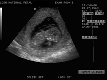 Abnormal Ultrasound